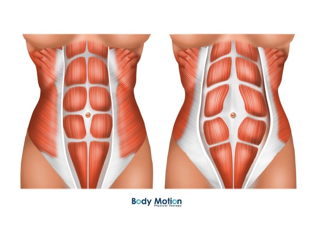 How To Check For Diastasis Recti