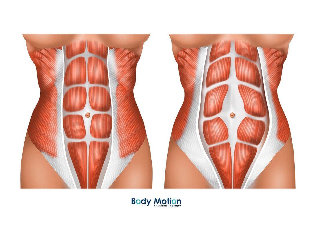 How To Check For Diastasis Recti